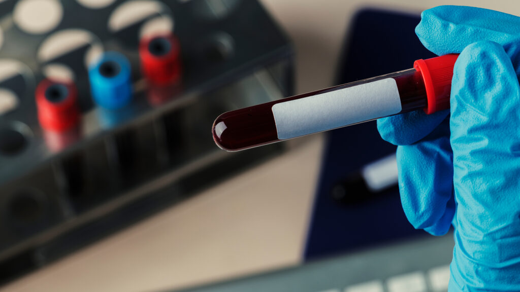 A phlebotomist holding a vial of blood for blood testing.